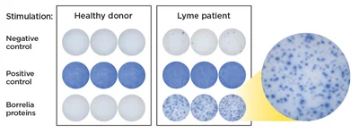 Tableau comparatif montrant les échantillons d'un donneur sain et d'un patient Lyme avec un zoom sur les protéines de Borrelia.